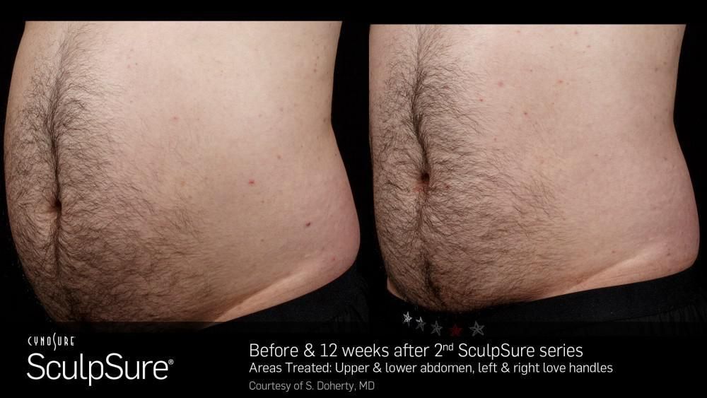 Looking for a Non-Surgical Alternative to Liposuction? Try WarmSculpting with SculpSure!