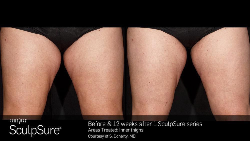 Combat Stubborn Fat with WarmSculpting by SculpSure