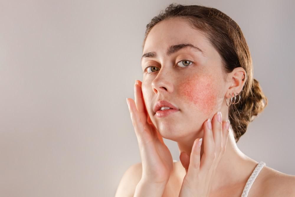 5 Symptoms of Rosacea