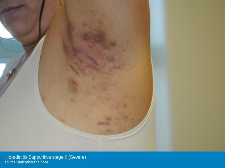 Hidradenitis Suppuritiva and Scar Removal - New Treatment