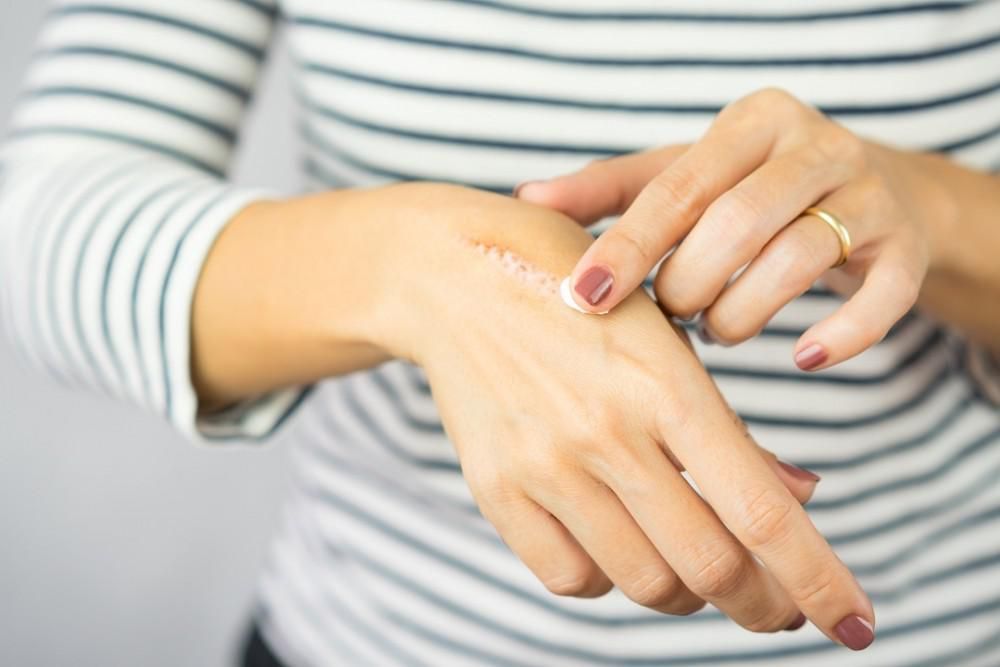 Are Scars Permanent?: Learn About our Laser Scar Removal Treatment