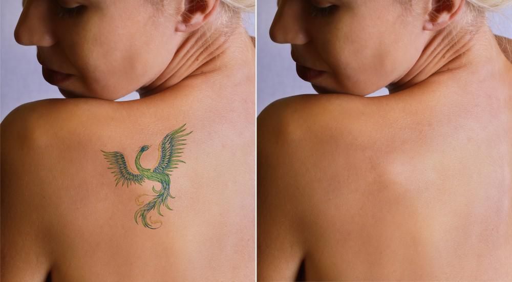 What To Expect When You're Planning to Remove Your Tattoo