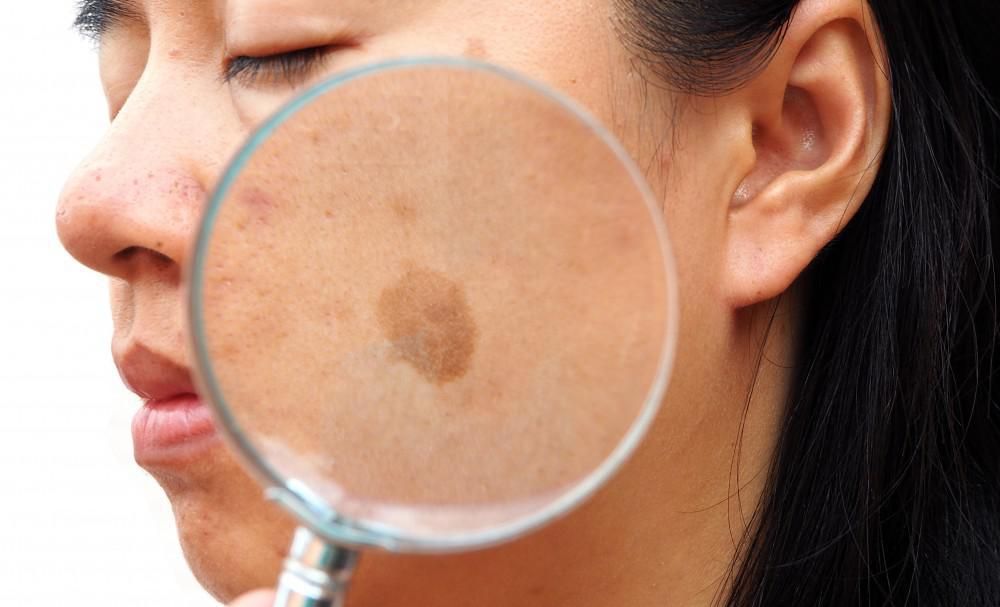 What Causes the Brown Patches of Melasma?
