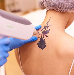 Tattoo Removal with PicoSure Laser