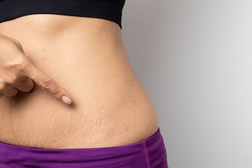 Stretch Marks: Causes, Treatment, and Prevention