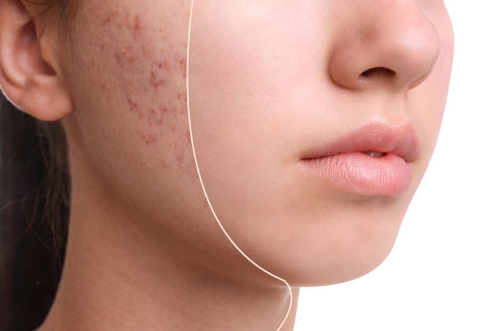 Defeating Acne Scars: Strategies for Prevention and Treatment