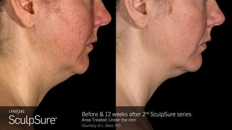 Best Non-Invasive Body Contouring, SculpSure Maryland