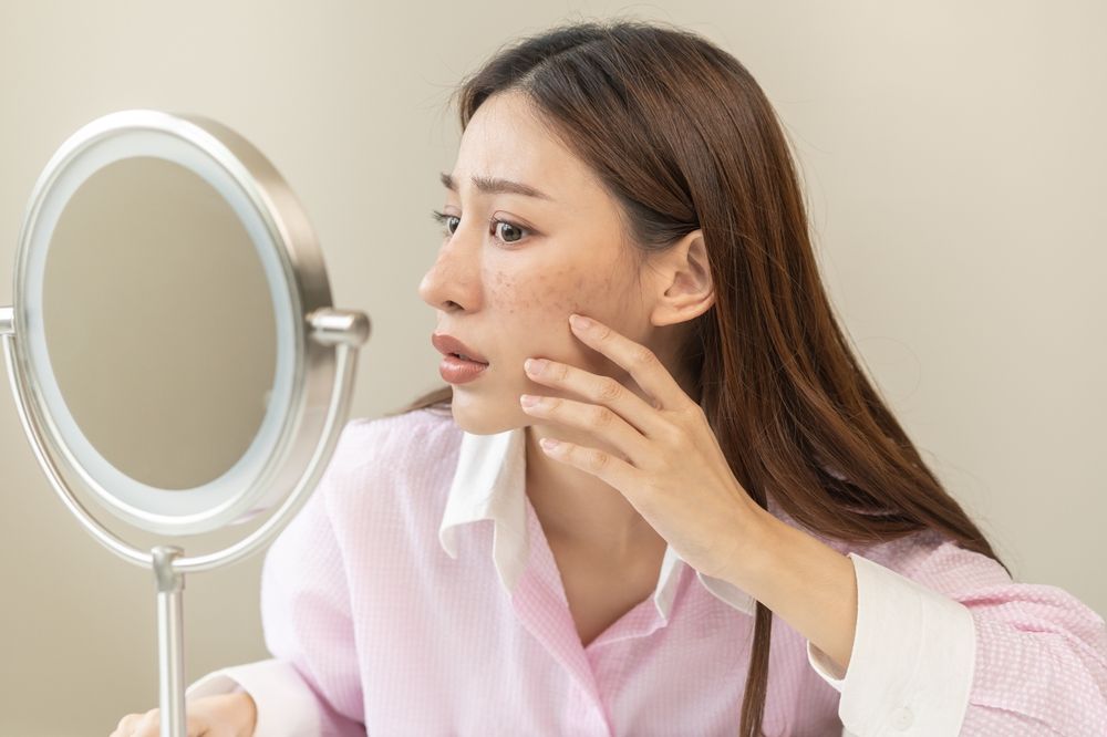 What’s the Best Treatment for Acne Scars?