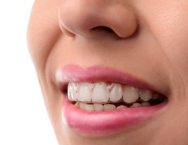 invisalign on girl's teeth