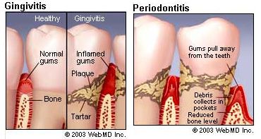 gingivitis periodontitis