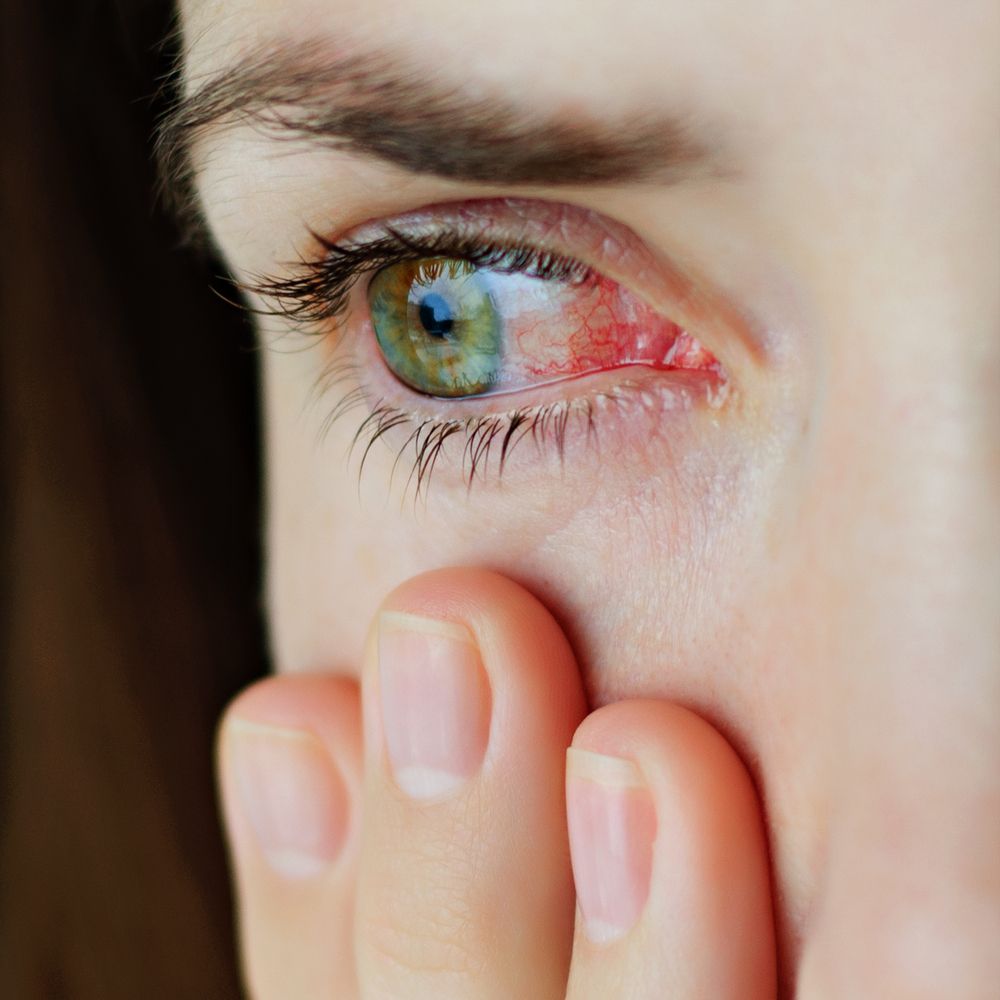Common Eye Allergy Triggers: Tips for Prevention