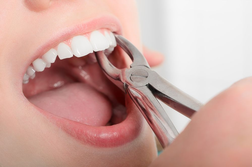 Smooth Tooth Extraction: Minimizing Pain, Maximizing Comfort