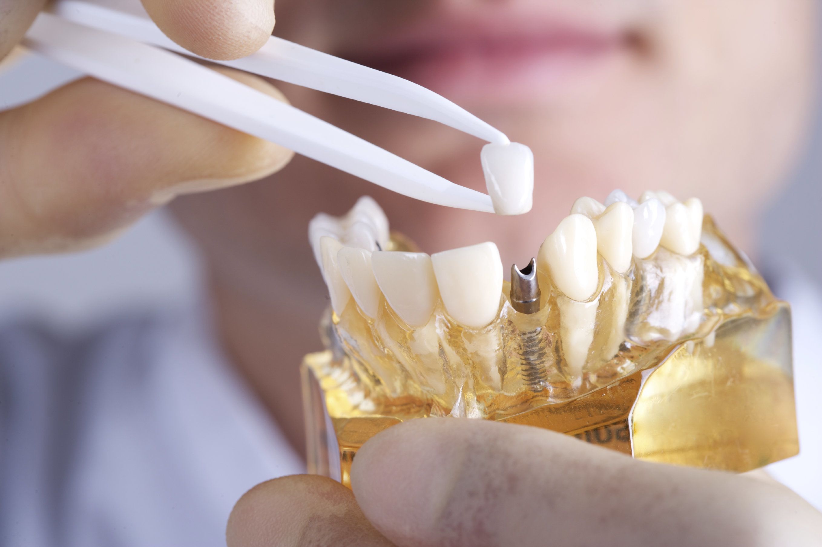 dental implant benefits