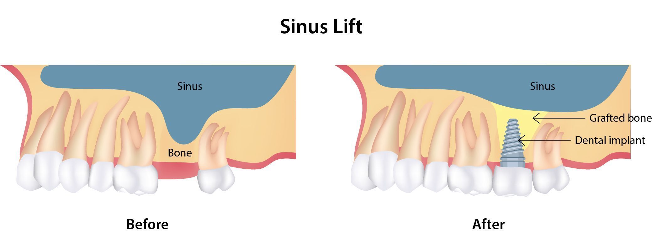 sinus lift