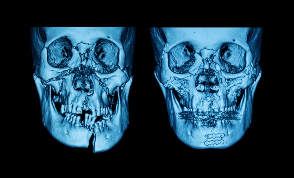 The Facial Fractures That Require Oral Surgery