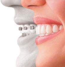 How does Invisalign compare to braces