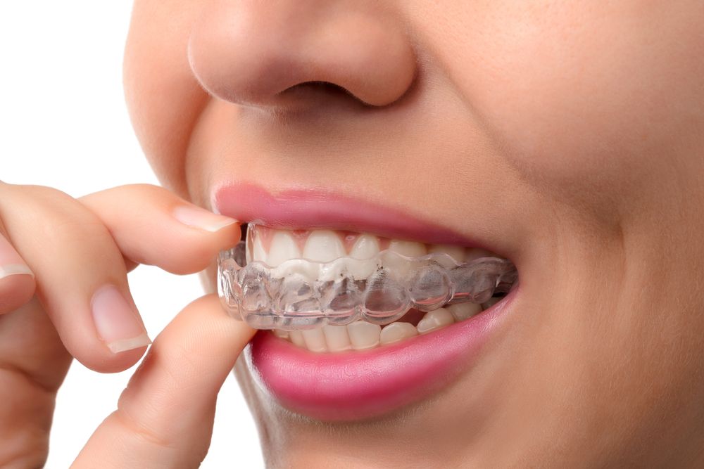 Maintaining A Healthy Enamel During Invisalign Treatment