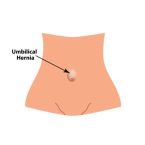 Umbilical hernia repair