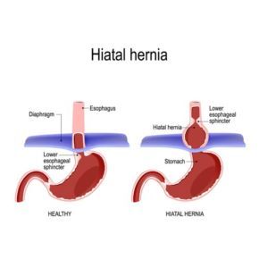 Hiatal Hernia repair