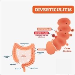 Diverticular surgery in Brooklyn	
