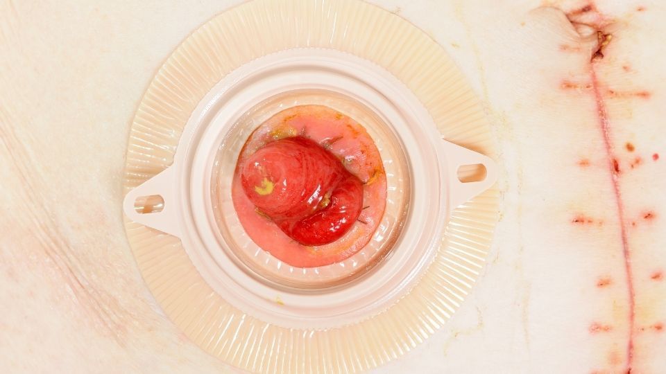 Know Your Surgeries: Ileostomy vs. Colostomy