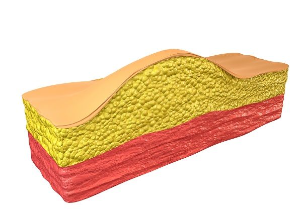 Why Do People Get Lipomas? Causes & Symptoms of Lipoma
