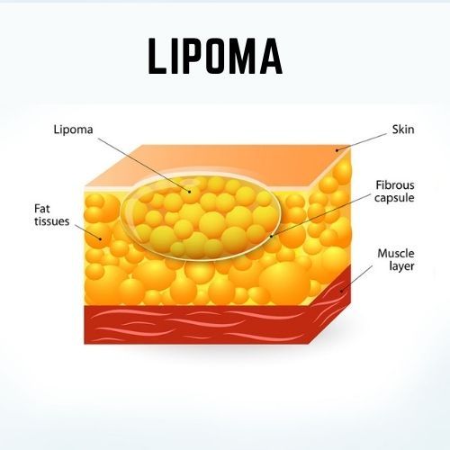 Lipoma removal