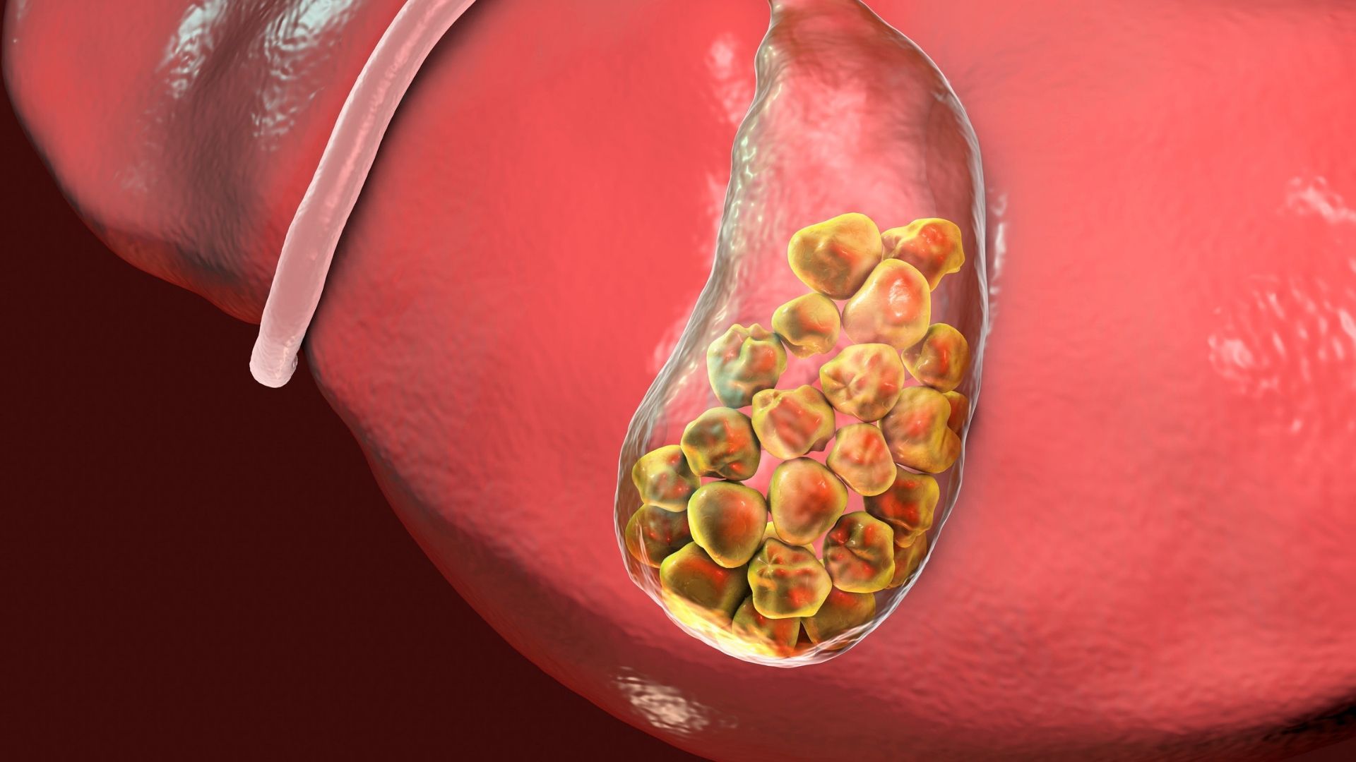 Best Tips for How to Prevent Gallstones and Gallstone Attacks