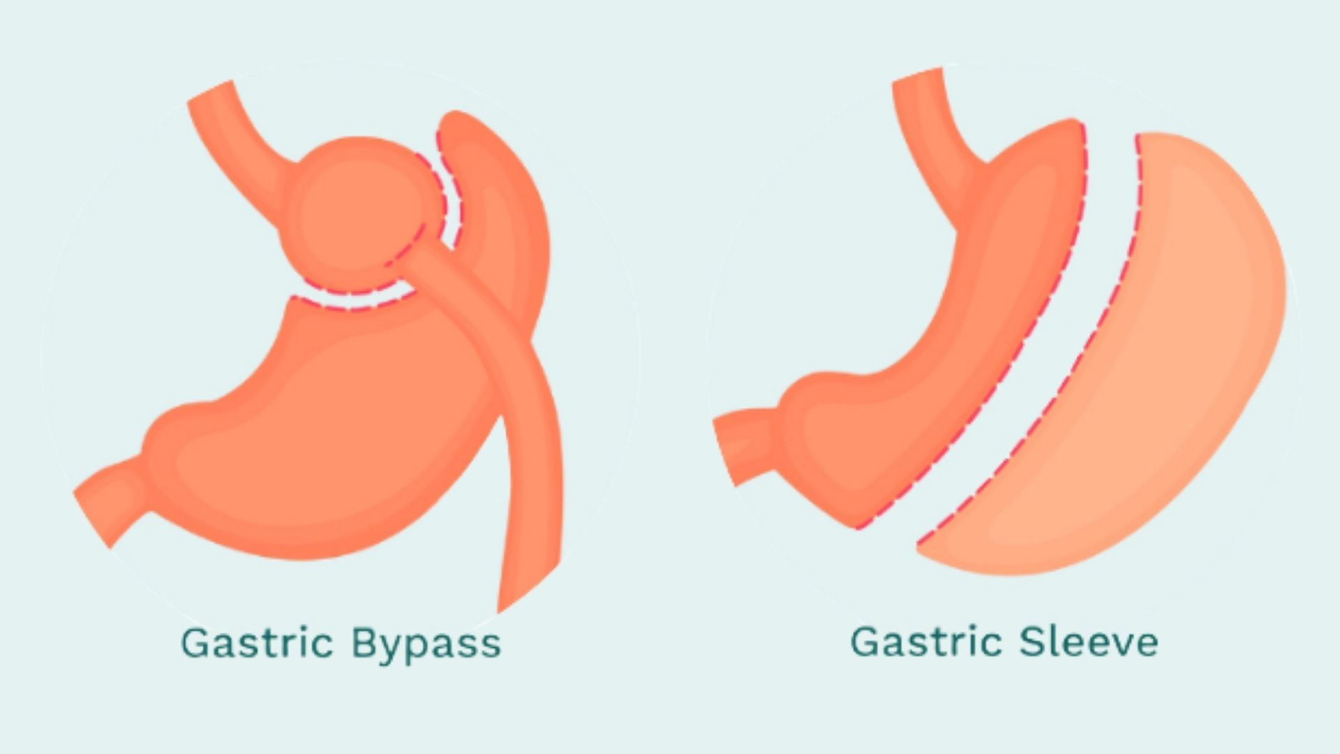 Gastric Sleeve vs. Gastric Bypass: The Main Differences Between Them