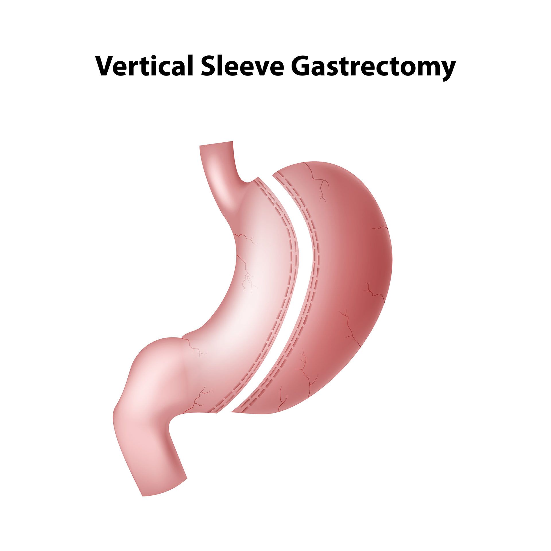 vertical sleeve gestrectomy