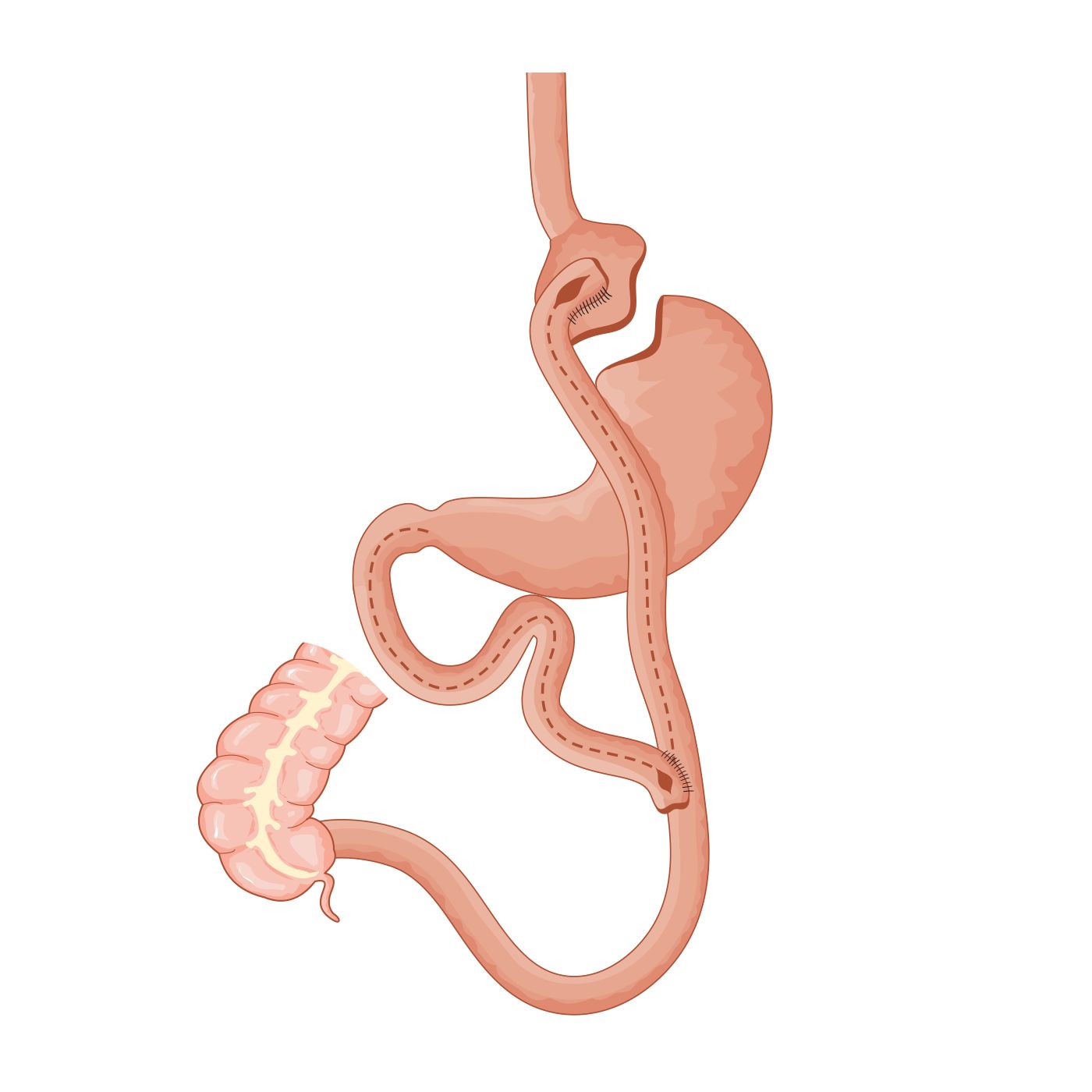 Laparoscopic Gastric Bypass