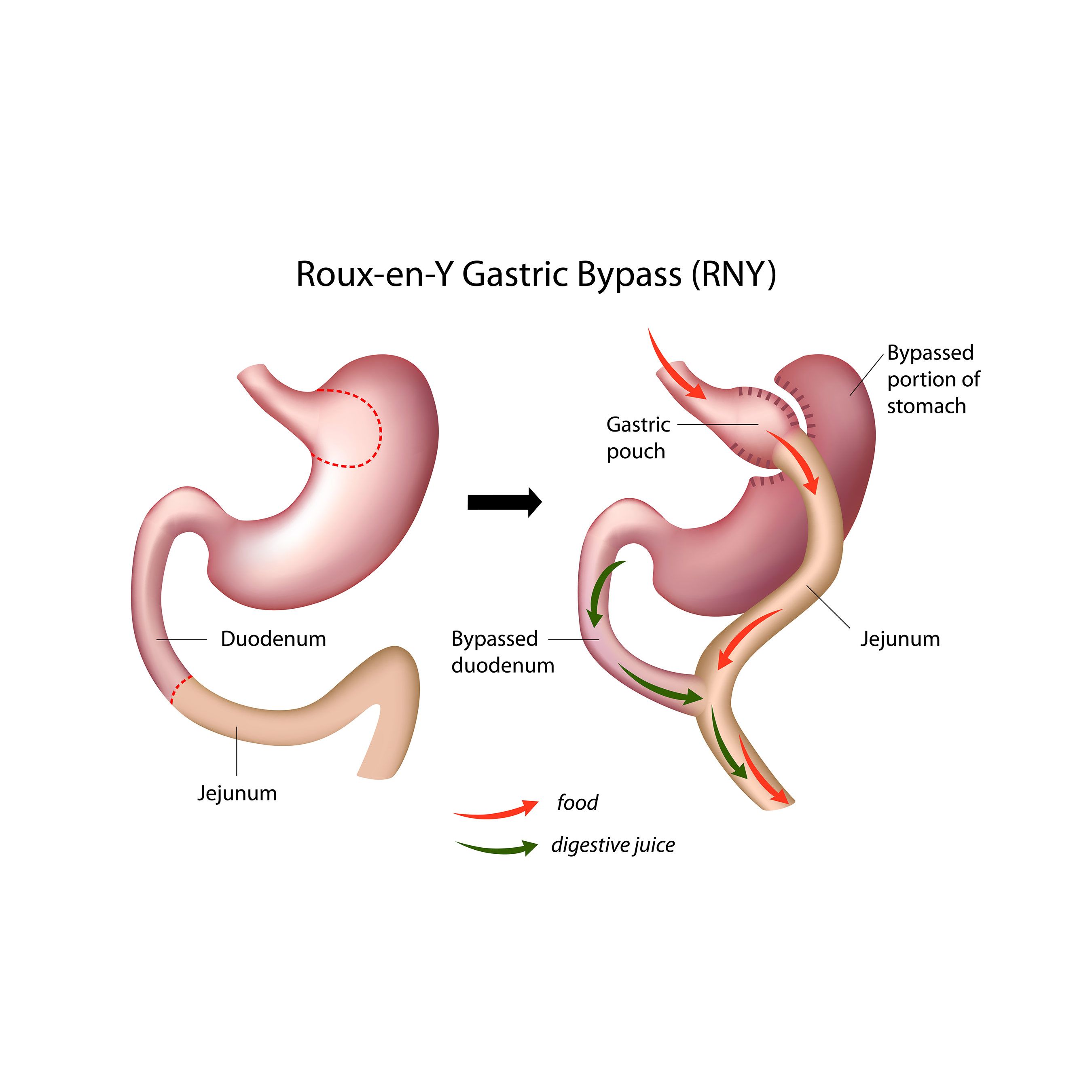 How Much Is Gastric Bypass Without Insurance When Am I Able To Drink