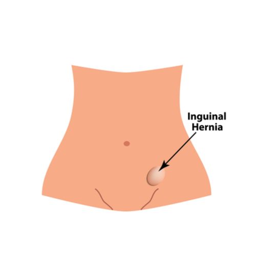 Inguinal Hernia repair