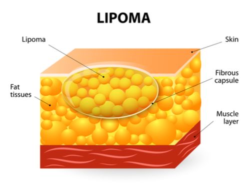 Lipoma/soft tissue Mass removal