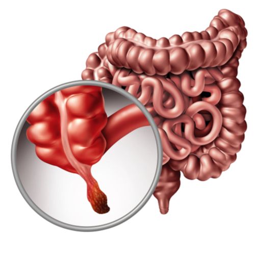 Appendix removal
