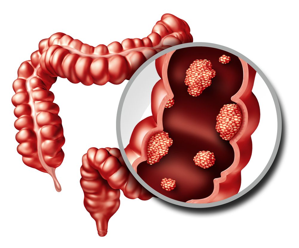 Colon Mass removal