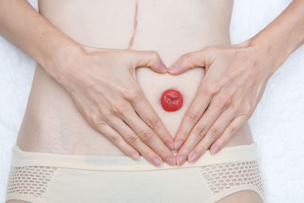Colostomy removal