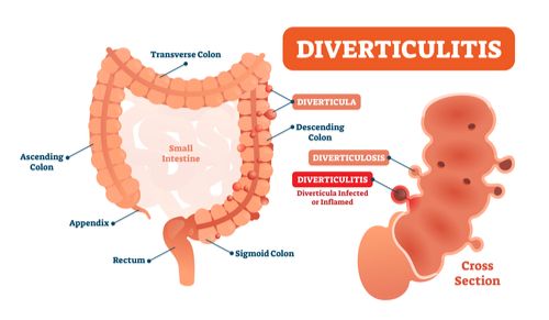 Diverticular surgery