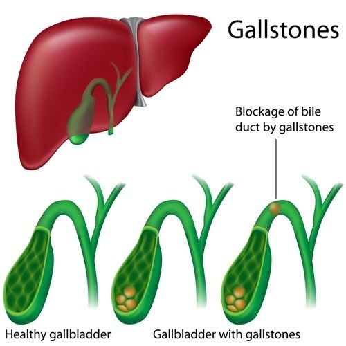 Gall Bladder removal