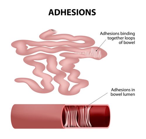 Intestinal Adhesion surgery