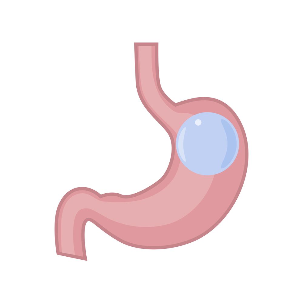stomach stapled side effects stomach stapled side effects