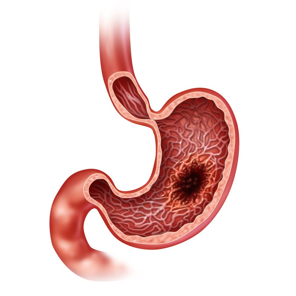 Stomach Mass removal