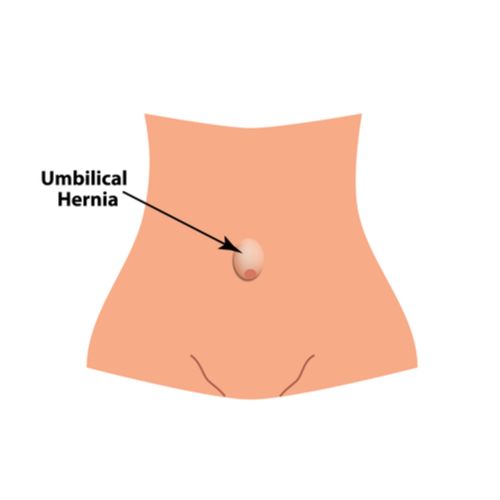 Umbilical Hernia repair