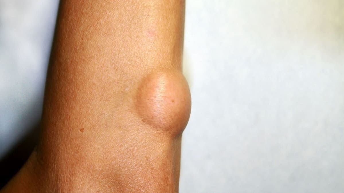 What Are Lipomas, and Can They Be Treated Naturally?