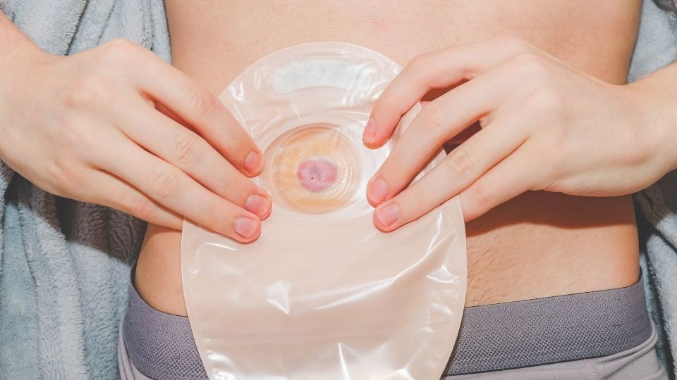 What Should I Expect After Colostomy Surgery?