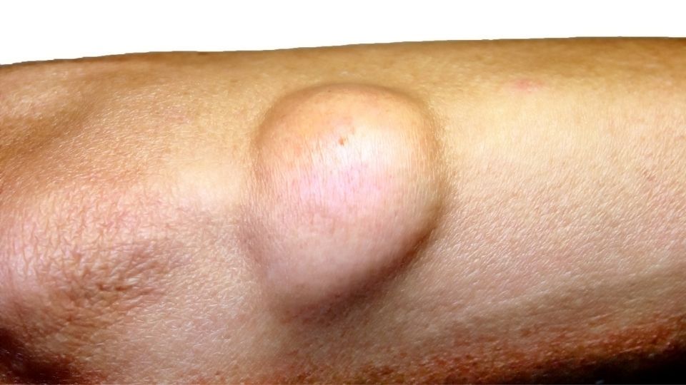 What Should You Expect After You Have Lipoma Removal Surgery?