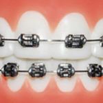 Metal Braces