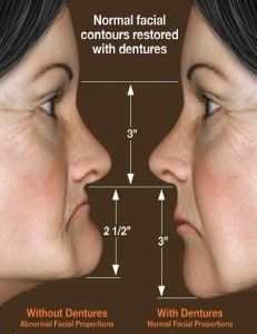 improve facial proportion with dentures