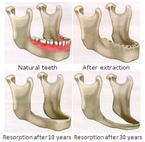 diagram of dentures