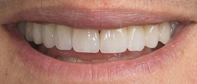 after closing tooth gap